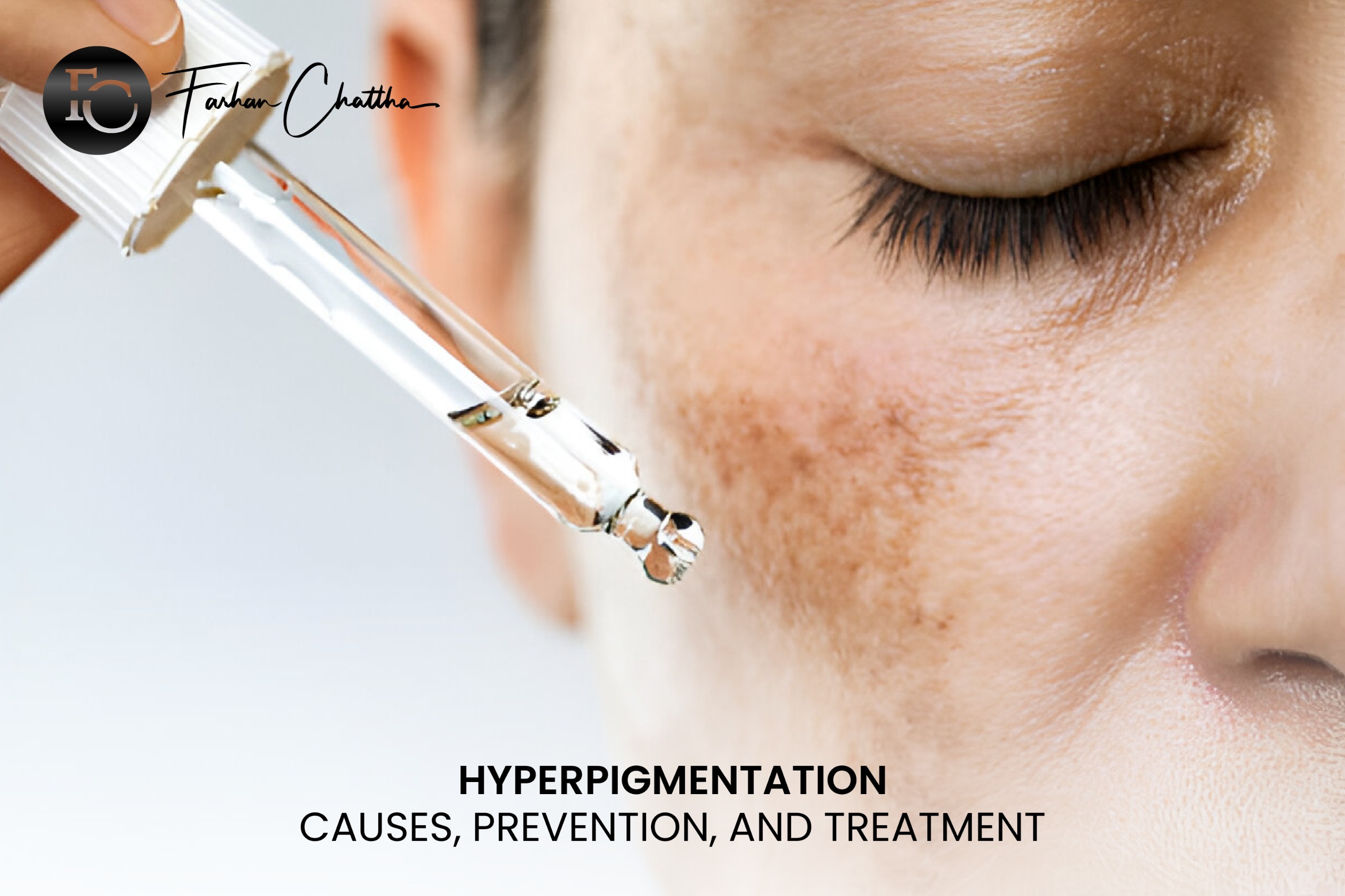Hyperpigmentation: Causes, Prevention, and Treatment